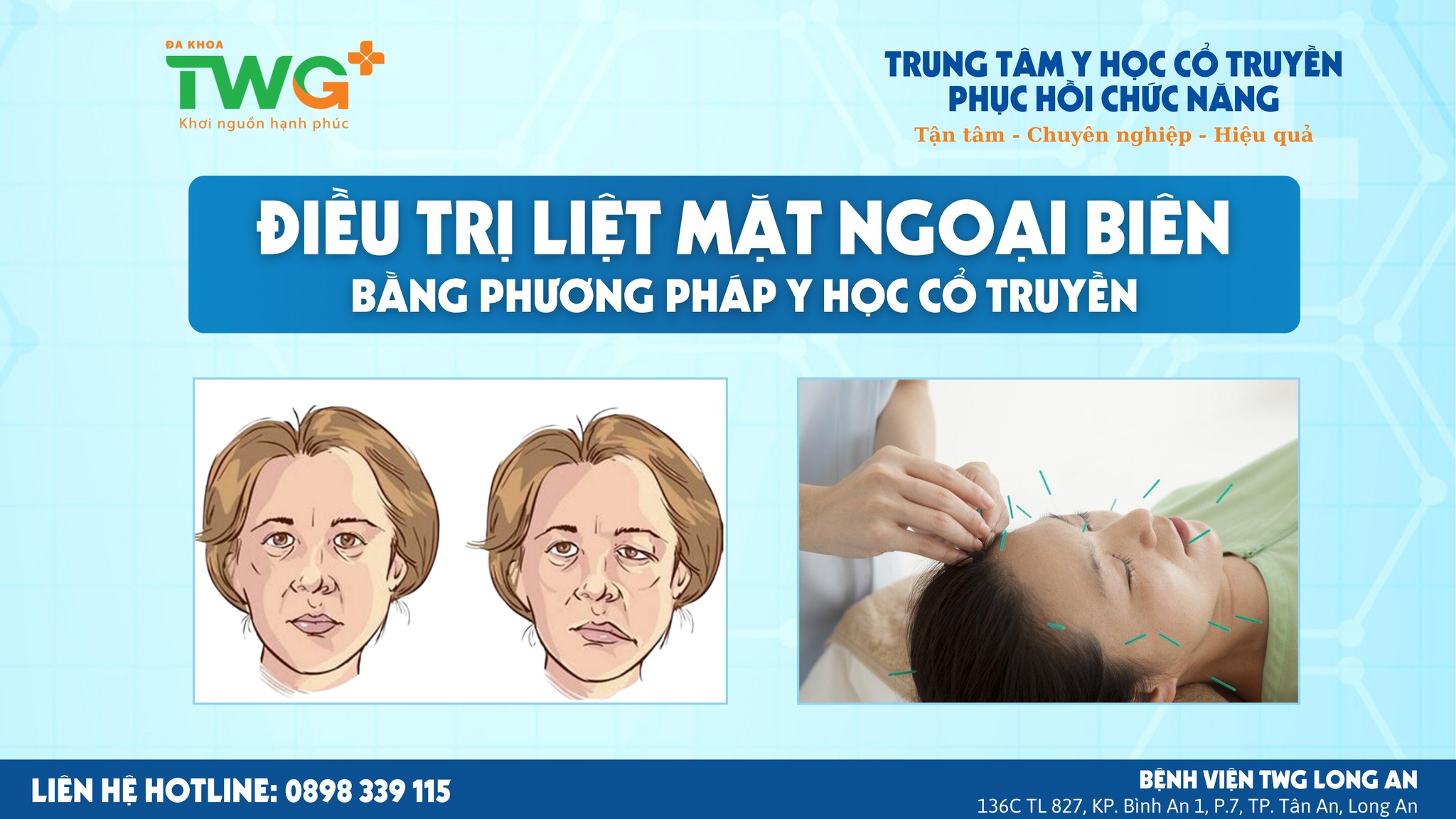 ĐIỀU TRỊ LIỆT NGOẠI BIÊN MẶT BẰNG Y HỌC CỔ TRUYỀN